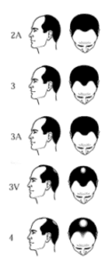 Male head illustrations with hair loss