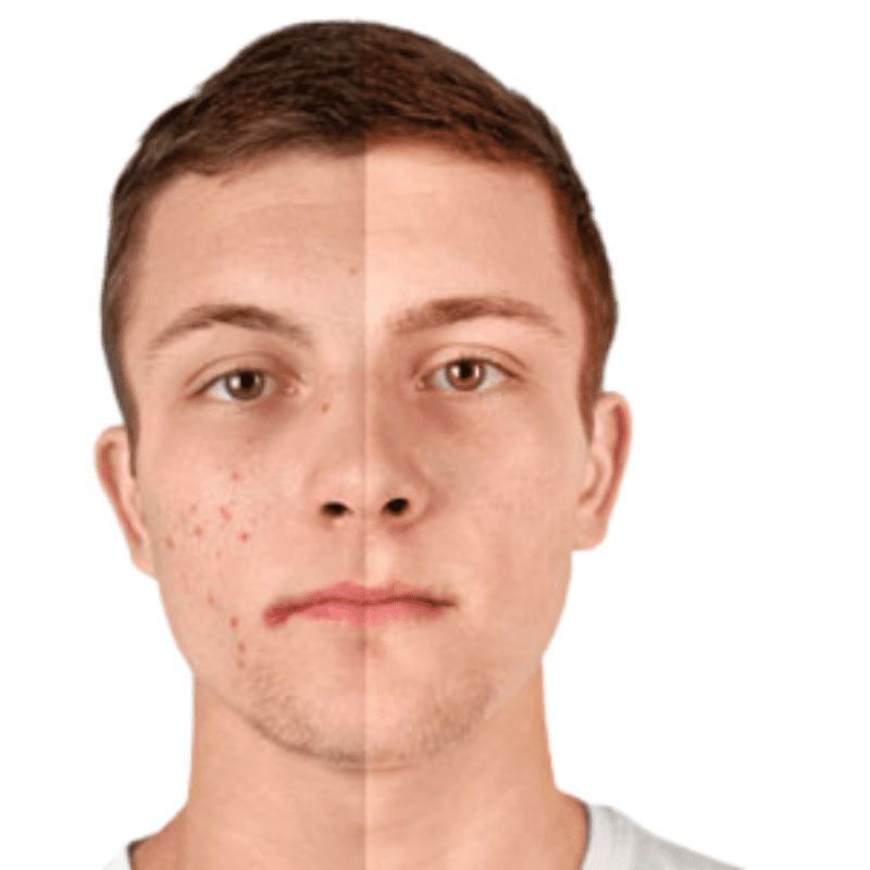 Young man with face split vertically and acne is on the left but not the right