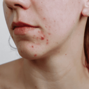 young girl with acne bumps on chin