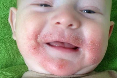 Atopic Dermatitis and Rash on Baby