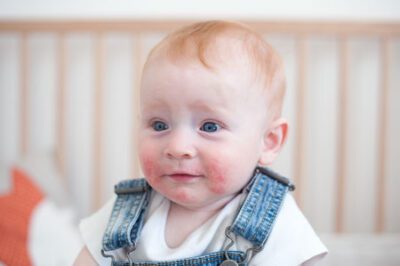 Atopic Dermatitis on Baby