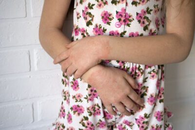 Contact Dermatitis on Hands and Arms