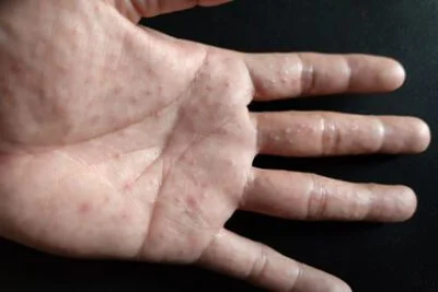 Dyshidrotic Eczema on Palm