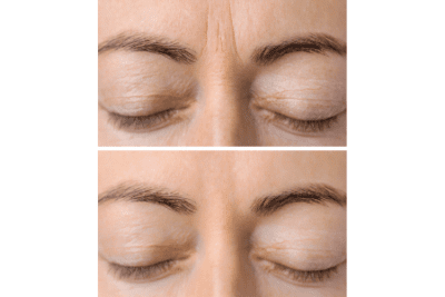 Eye wrinkles before and after