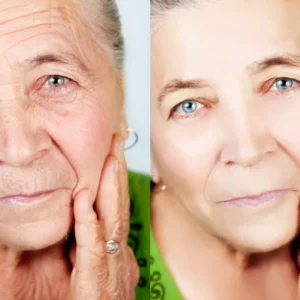 before and after wrinkle reduction therapy