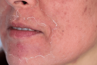 Acne Scar Chemical Peel