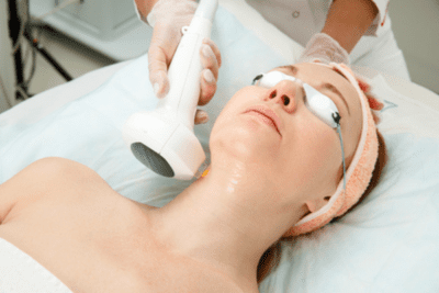 Acne scar laser therapy