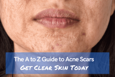 The A to Z Guide to Acne Scars: Get Clear Skin Today