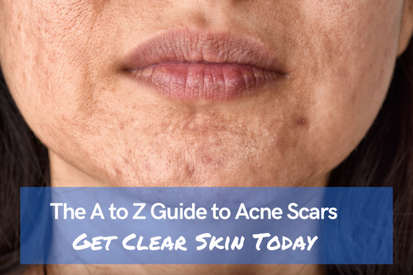 The a to z Guide to Acne Scars Get Clear Skin Today