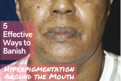 5 Effective Ways to Banish Hyperpigmentation Around the Mouth