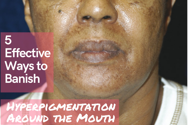 5 Effective Ways to Banish Hyperpigmentation Around the MouthFour Types of Hyperpigmentation and What Causes Them