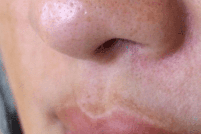 Hyperpigmentation above the lip