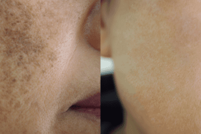 Hyperpigmentation on the cheek