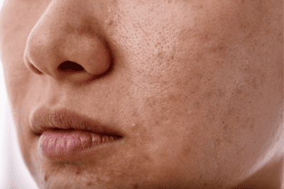 Inflammatory skin conditions such as acne can cause dark spots
