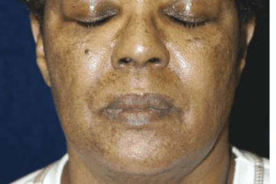 Post inflammatory hyperpigmentation from skin trauma around the mouth