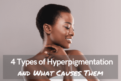The Four Types of Hyperpigmentation and What Causes Them