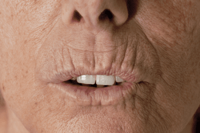 Wrinkles around the mouth from smoking
