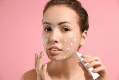 Girl applying benzoyl peroxide to acne on her face