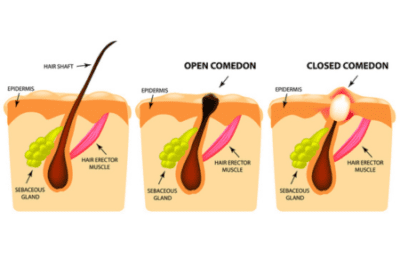 Hair follicles with an open comedone (blackhead) and a closed comedone (whitehead)