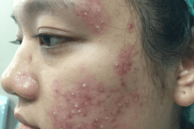 Woman with severe acne and inflammation after laser therapy and chemical peel