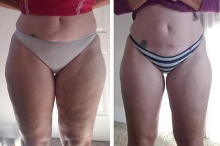 Nushape Lipo Wrap Before and After (cellulite and waist)